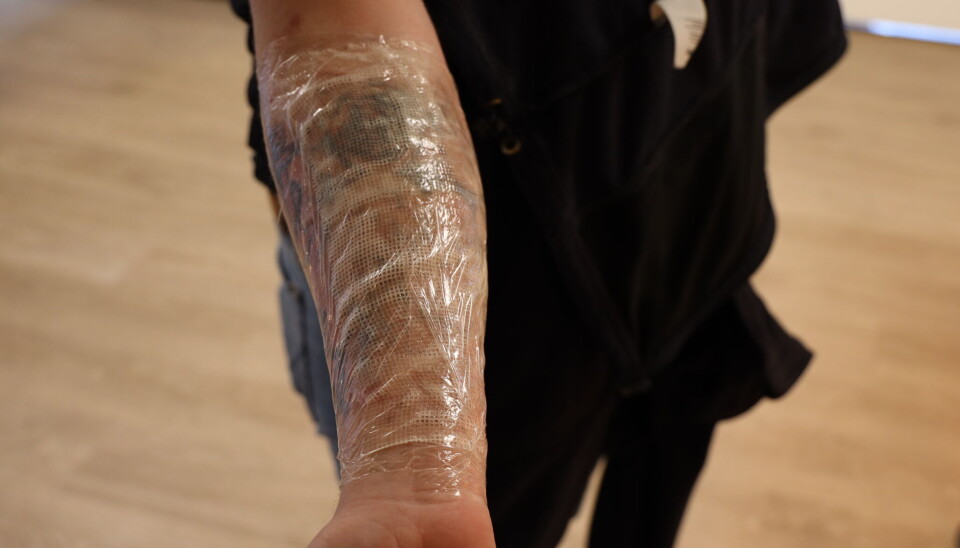 'Sigurd' har akkurat hatt sin andre behandling med laser.
