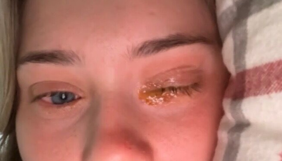 ALLERGI: Bilete frå Elida sin allergiske reaksjon på pollen, som ho og legen hennar meiner er vorte verre på grunn av serumbruken. Her etter å ha våkan med hove auge som ho ikkje klarte å opne.
