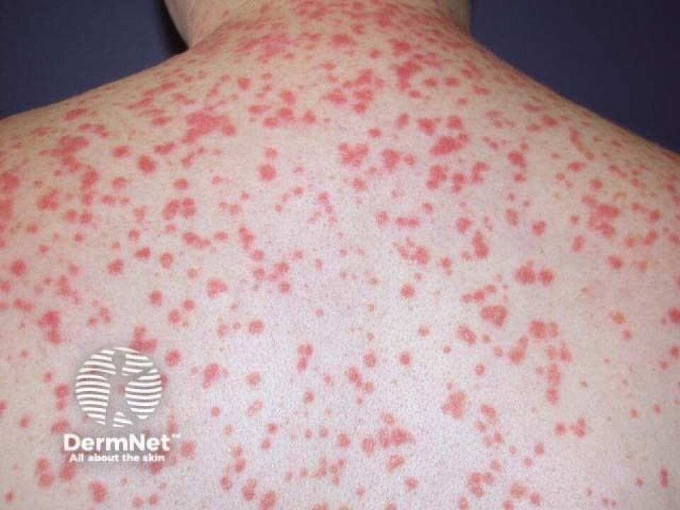 Tilfelle av Guttat psoriasis på hvit hud, hentet fra Dermnetnz.org Link:https://dermnetnz.org/imagedetail/17425-guttate-psoriasis