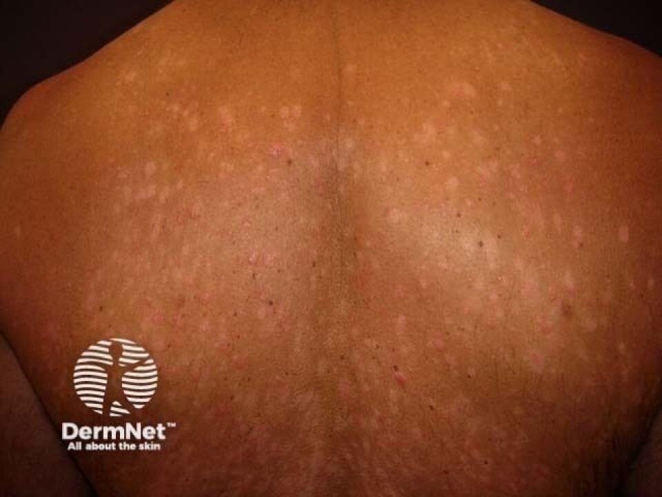 Tilfelle av Guttat psoriasis på mørk hud, hentet fra Dermnetnz.org Link:https://dermnetnz.org/imagedetail/17430-guttate-psoriasis